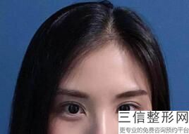 双眼皮6d和埋线的区别，7d双眼皮是埋线吗