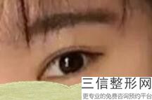 双眼皮失败修复的较好时间是什么时候(双眼皮失败比较早什么时候可以修复)