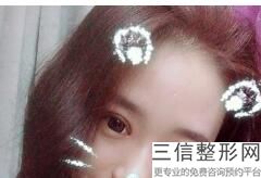 双眼皮手术打麻药疼不疼，割双眼皮打麻药很痛吗