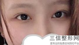 双眼皮手术进行多久，做双眼皮手术需要多长时间恢复