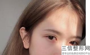 双眼皮手术是小手术吗，小眼睛双眼皮手术