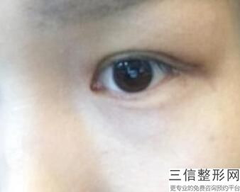 双眼皮术后拆线痛吗，双眼皮手术拆线会疼吗