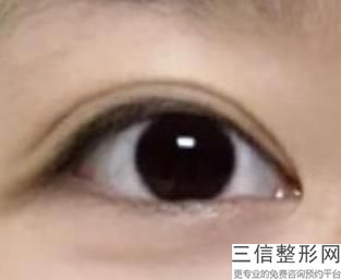 双眼皮术后很对称,恢复期不对称了，双眼皮手术左右眼不对称怎么办