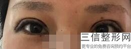 双眼皮术后怎么护理步骤,双眼皮术后应该怎样护理更合适呢
