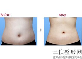 水动力大腿抽脂亲身经历日记，水动力吸脂可以全身做吗