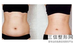 臀部吸脂的危害，臀部可以做吸脂吗