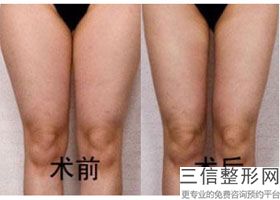 臀线吸脂和臀部吸脂的区别,臀上吸脂部位