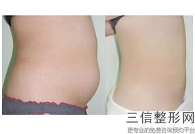 脱腿毛大概要多少钱，大腿脱毛多少钱_1