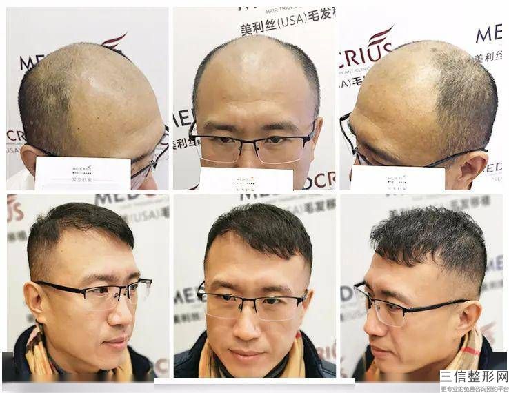无痕植发怎么样，无痕植发有用么