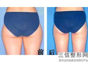 吸脂手术后如何护理，手臂吸脂术后需要注意什么