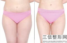 吸脂为什么不能吸臀部，臀部能吸脂吗