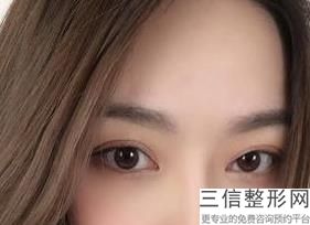 西安双眼皮整形，你们都在西安哪里做的双眼皮