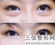 消除眼袋法怎样祛眼袋，祛除眼袋良好方法