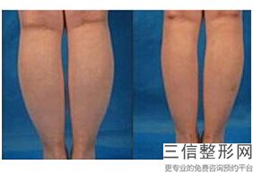 小腿抽脂一般多少钱，抽脂大腿小腿多少钱