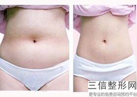 小腿抽脂一般多少钱，抽脂大腿小腿多少钱