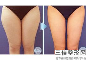 小腿抽脂一般多少钱，抽脂大腿小腿多少钱
