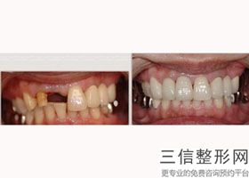 牙齿打桩后可以直接戴牙冠，牙冠都需要打桩吗