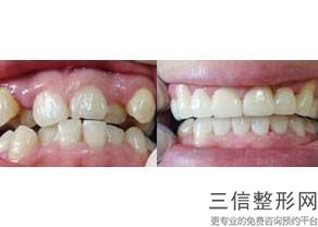牙齿黄洗牙能洗白吗，牙齿很黄去洗牙能洗白吗