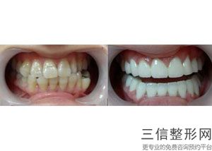 牙齿矫正的好处有哪些，为什么要矫正牙齿-牙齿矫正的好处