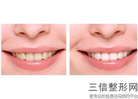 牙齿矫正哪种效果比较好，牙齿矫正效果好不好