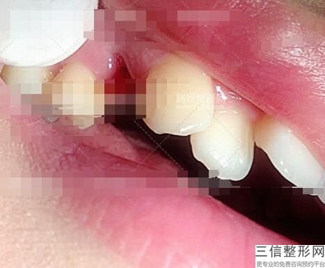 牙齿美白良好的方式,哪种牙齿美白效果好