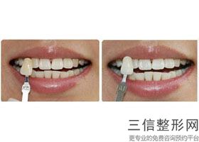 牙齿全瓷贴面的价格是多少，全瓷牙贴面的价格
