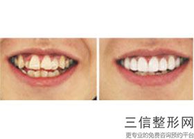牙齿全瓷贴面的价格是多少，全瓷牙贴面的价格