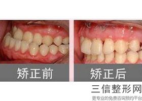 牙齿稀疏怎么治良好的办法,牙齿稀疏如何处理
