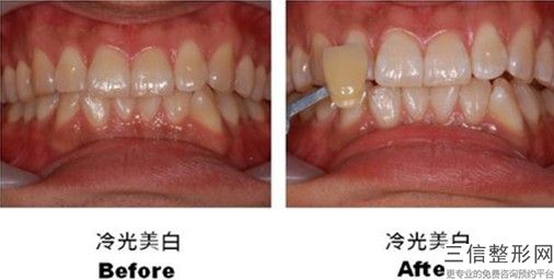牙齿拥挤有什么坏处，牙齿拥挤是怎么造成的