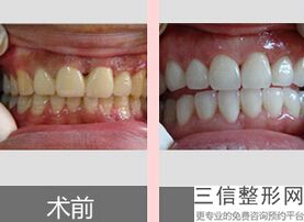 牙齿有洞能不能补，牙齿有洞是不是一定要补
