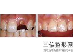 牙冠全瓷冠多少钱，一般全瓷冠多少钱一颗