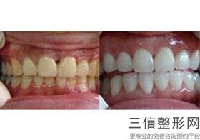 牙冠全瓷冠多少钱，一般全瓷冠多少钱一颗