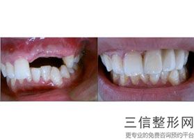 牙套的种类，牙套分别有几种