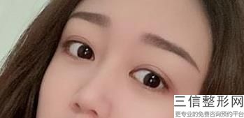 亚韩祛眼袋，韩式眼袋整形
