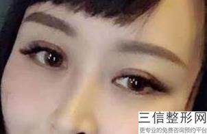 亚韩祛眼袋，韩式眼袋整形
