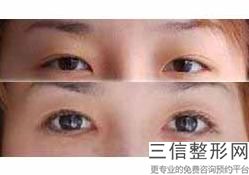 眼部整形哪个做好，眼部整形哪家好