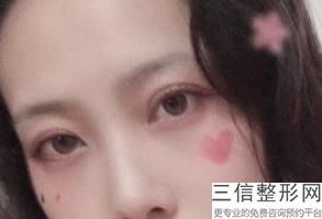 眼部整形手术要多少钱，眼部整形术费用多少
