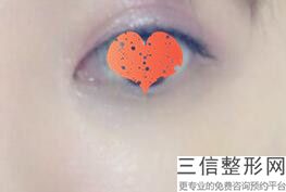 眼部整形手术要多少钱，眼部整形术费用多少