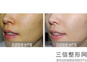 眼皮下垂做什么医美，上眼皮松弛 医美