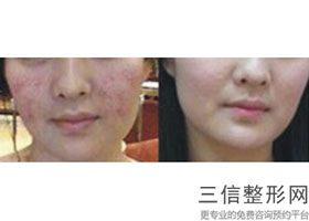 眼下抽脂大约需要多少钱，眼部抽脂去皮多少钱