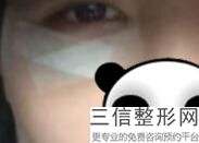 眼线纹完了多久能恢复，纹眼线要多长时间恢复