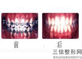 一颗牙做牙冠要磨牙吗，前磨牙需要做牙冠吗
