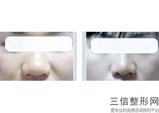 伊凡露隆鼻是长久的吗，伊凡露注射隆鼻价格