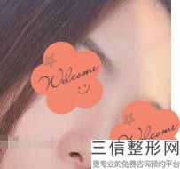 伊维兰注射隆鼻10了,能取干净吗-，专业伊维兰注射医院