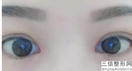 有没有超声波去眼袋的，做超声波去眼袋一般多少钱