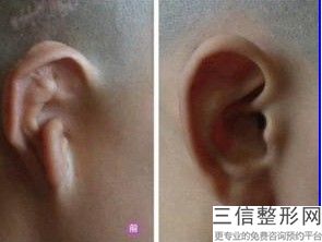 招风耳整形有后遗症吗，招风耳整形后