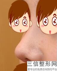 整个鼻头缩小大概多少钱，做鼻头缩小价格