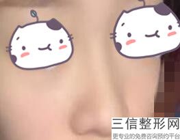 整容鼻形都有什么样，鼻整形有哪些