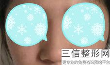 整容鼻形都有什么样，鼻整形有哪些