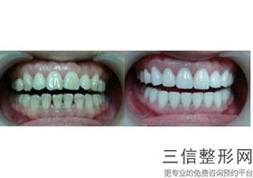 整形医院的牙齿美白有用吗，医院是怎么美白牙齿的